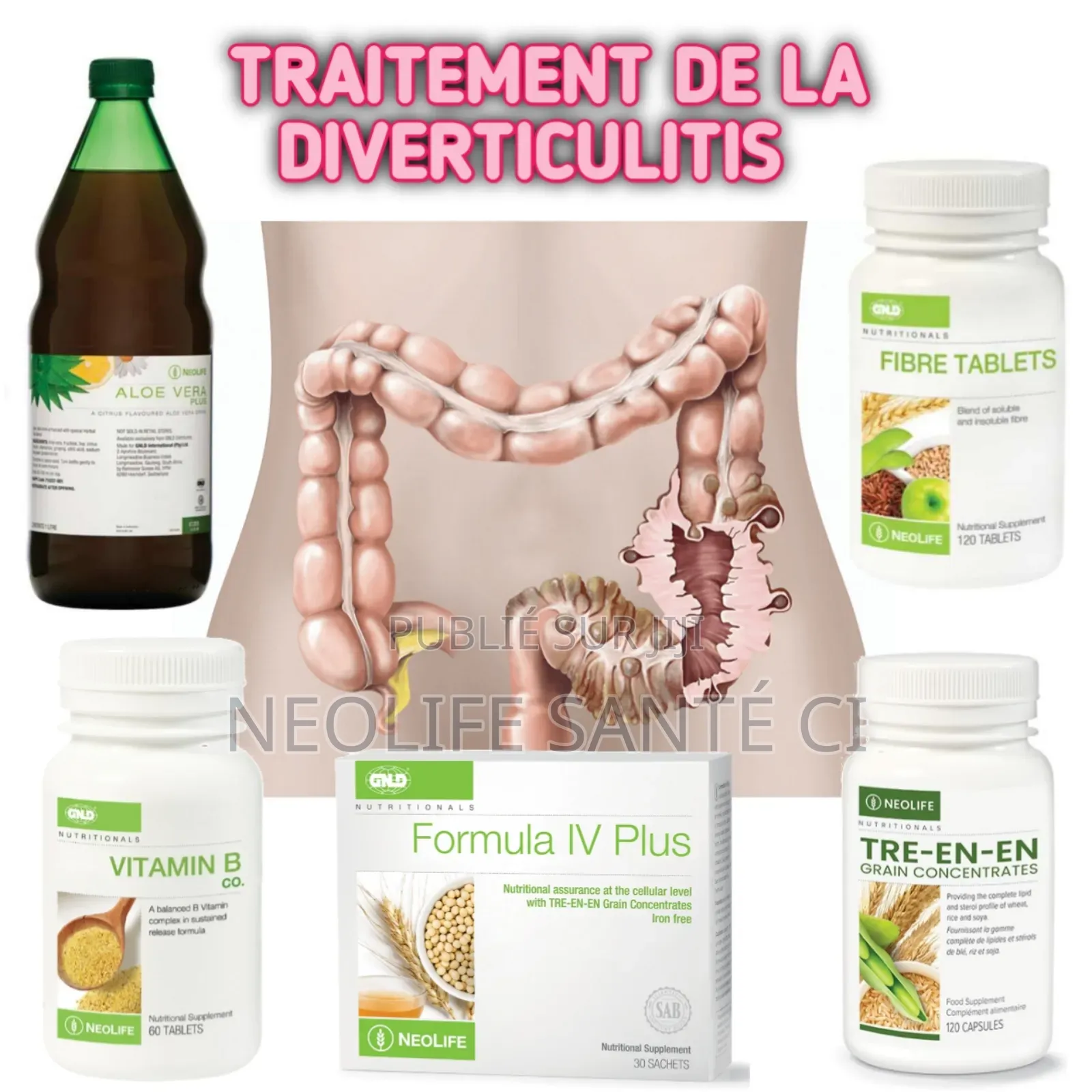 Diverticulitis