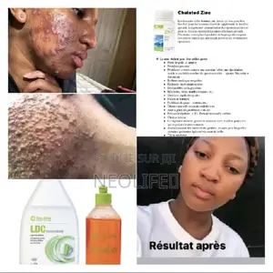 Traitement De l'Acné Et Des Problèmes De Peau.