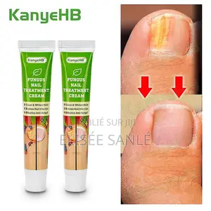 Crème Antifongique Pour Les Ongles Des Pieds