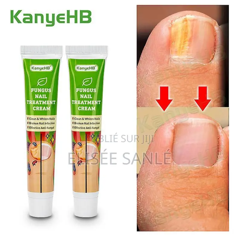 Crème Antifongique Pour Les Ongles Des Pieds